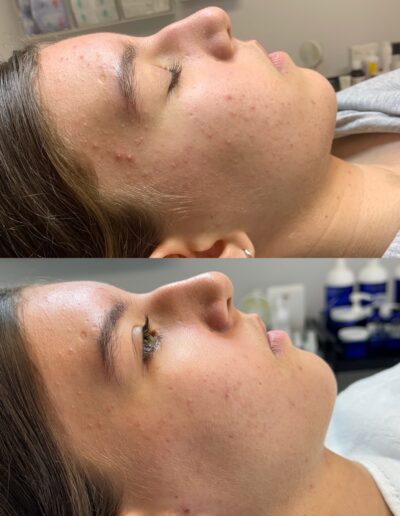 Acne-behnadeling picture