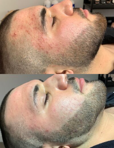 Hoe-verminder-je-acne