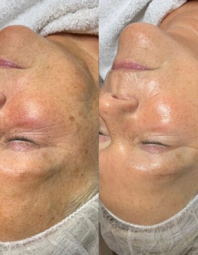 Pigmentvlekken-verminderen-met-crytherapie