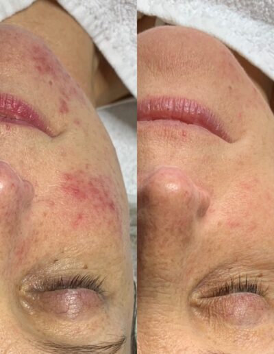 hoe-kan-ik-rosacea-het-beste-behandelen