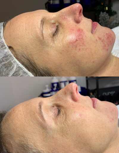 ontstaat-rosacea-door-de-demodexmijt