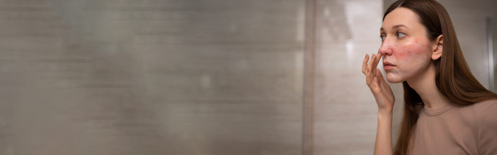 rosacea-banner