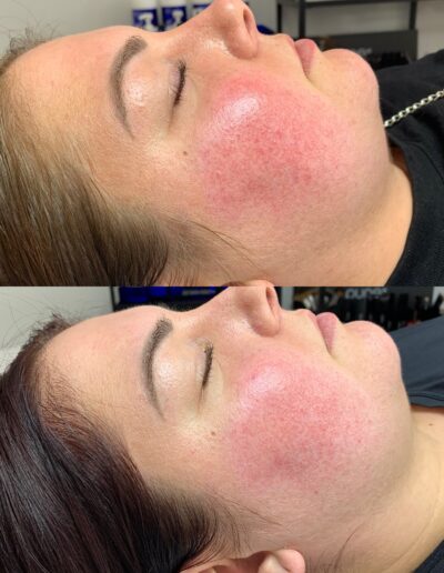 rosacea-verminderen-door-zo-skin.-health