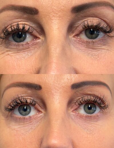 anti aging before and after