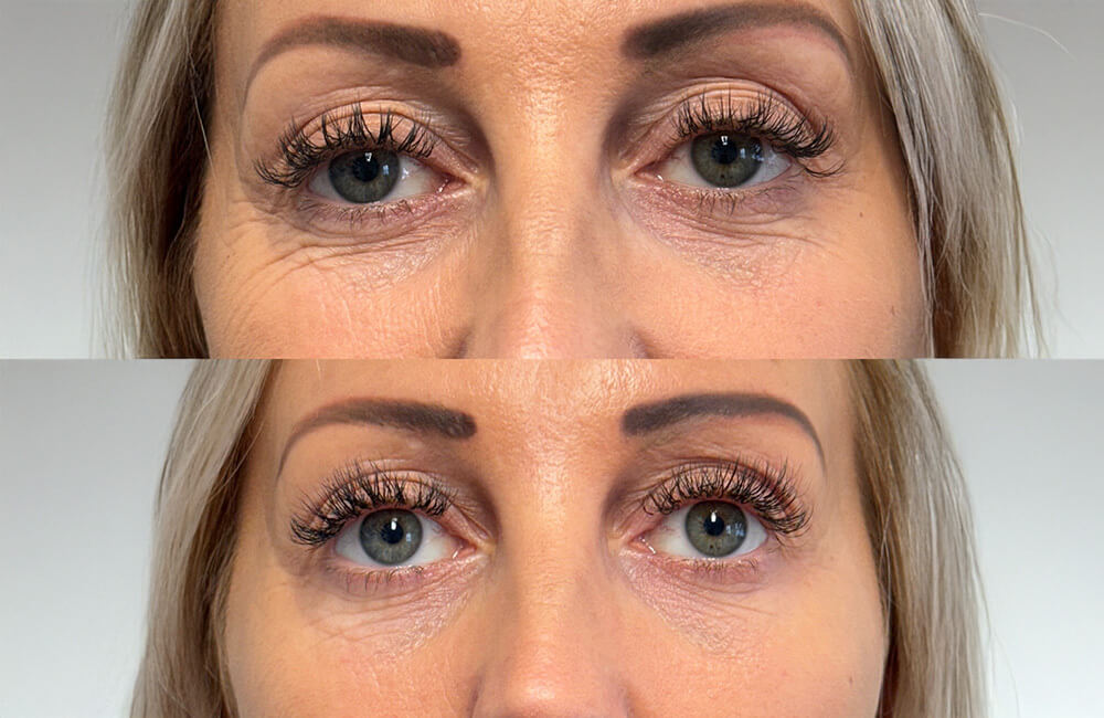 anti aging before and after